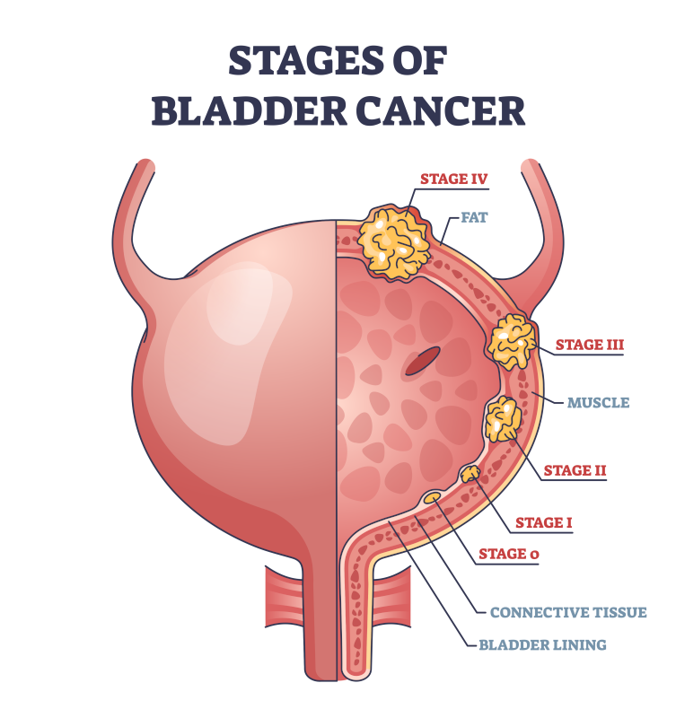 Medical illustration of the stages of bladder cancer in cut away view, from stage 0 in the bladder lining through stage I in the connective tissue, stage II in the bladder muscle, stage III in the surrounding fat and stage IV beyond it