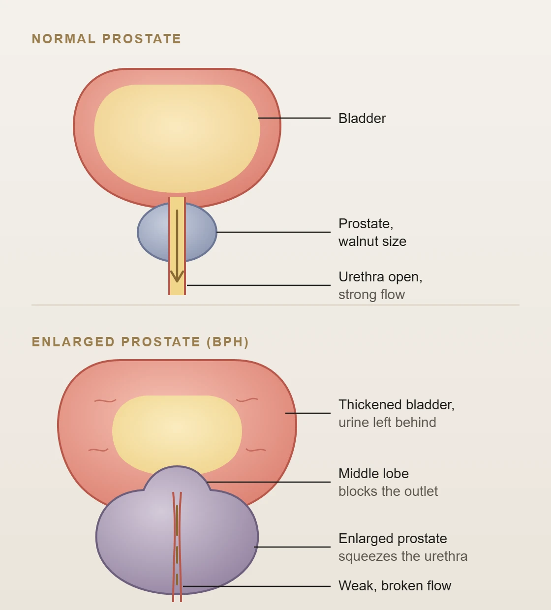 Labelled illustration comparing a normal prostate with an enlarged prostate: the enlarged gland and its middle lobe squeeze the urethra, the bladder wall thickens and urine is left behind, giving a weak, broken flow