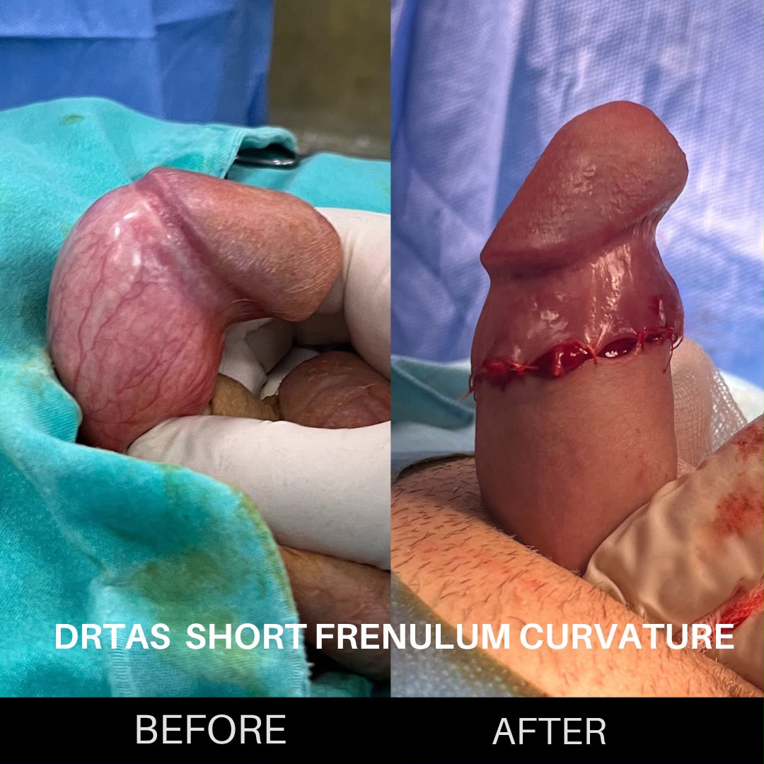 Penile Curvature before and after result 2