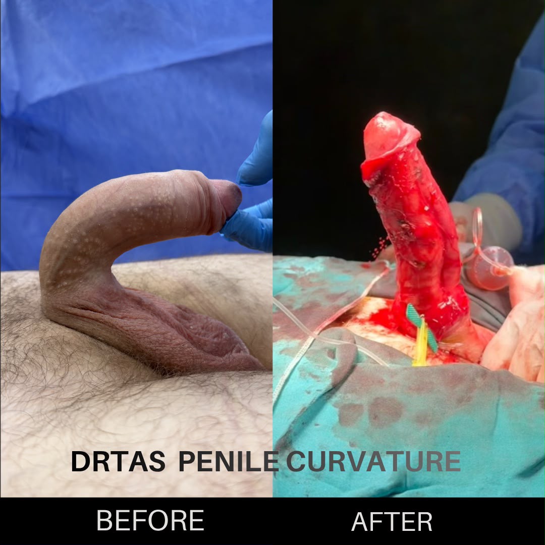 Penile Curvature before and after result 3
