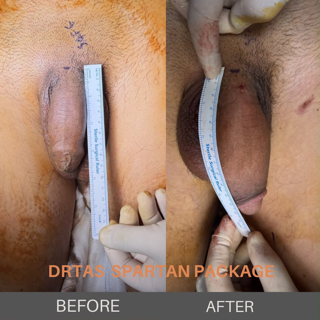 Penile Enlargement before and after result 10