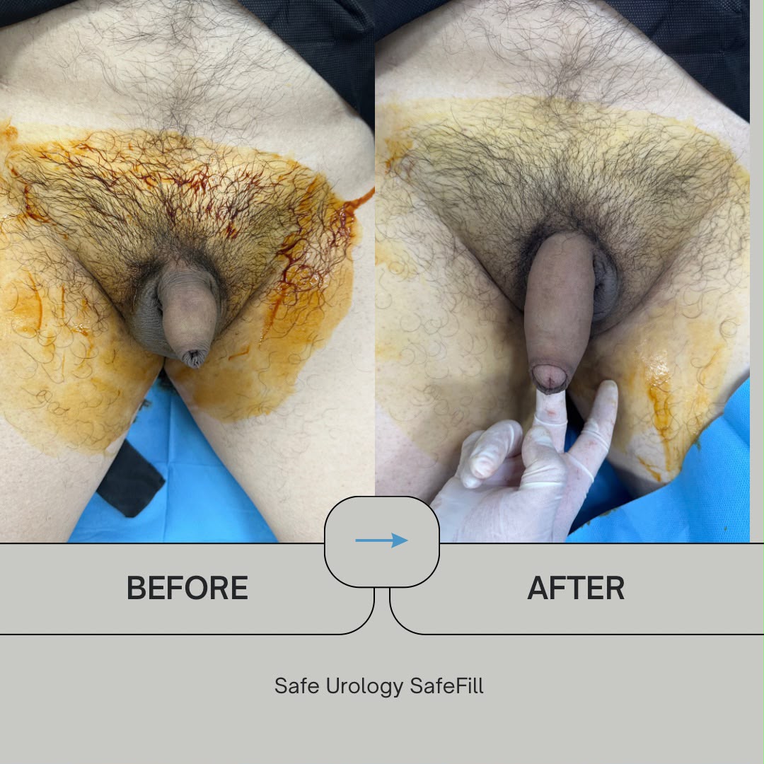 Penile Enlargement before and after result 3