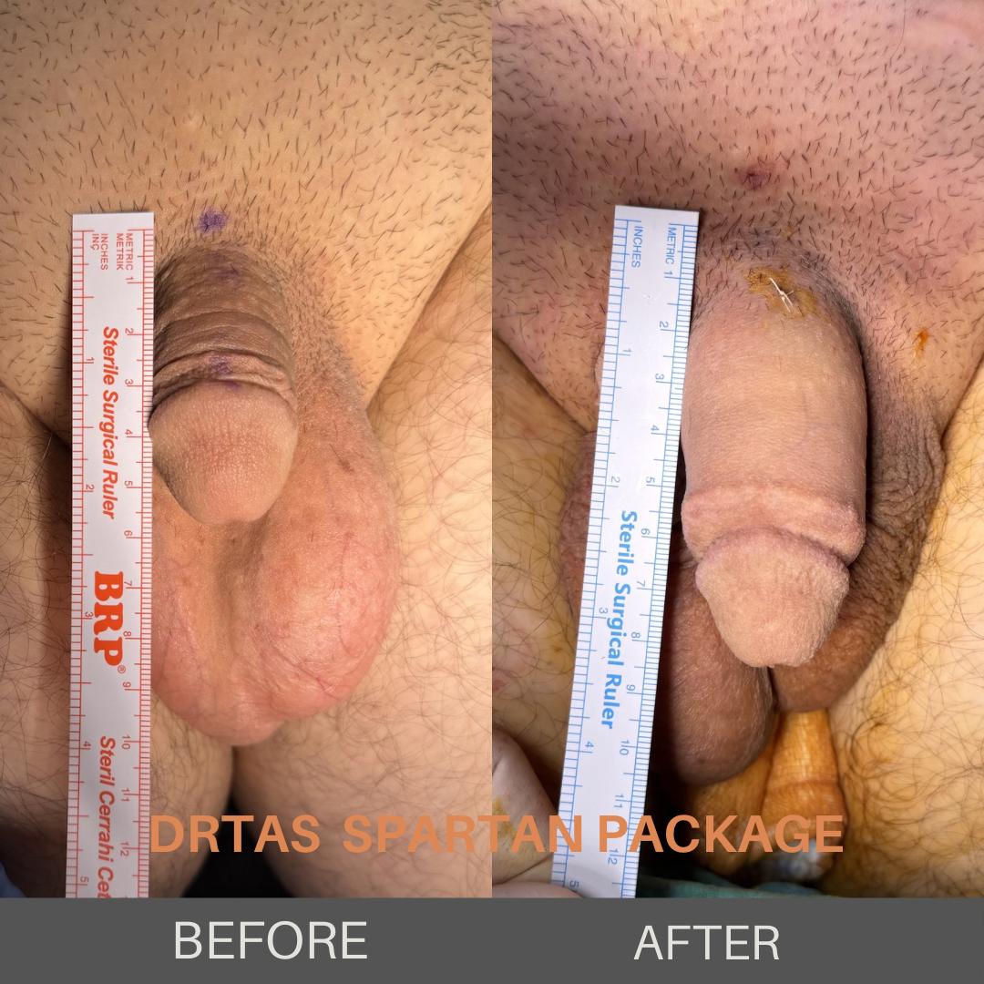 Penile Enlargement before and after result 5
