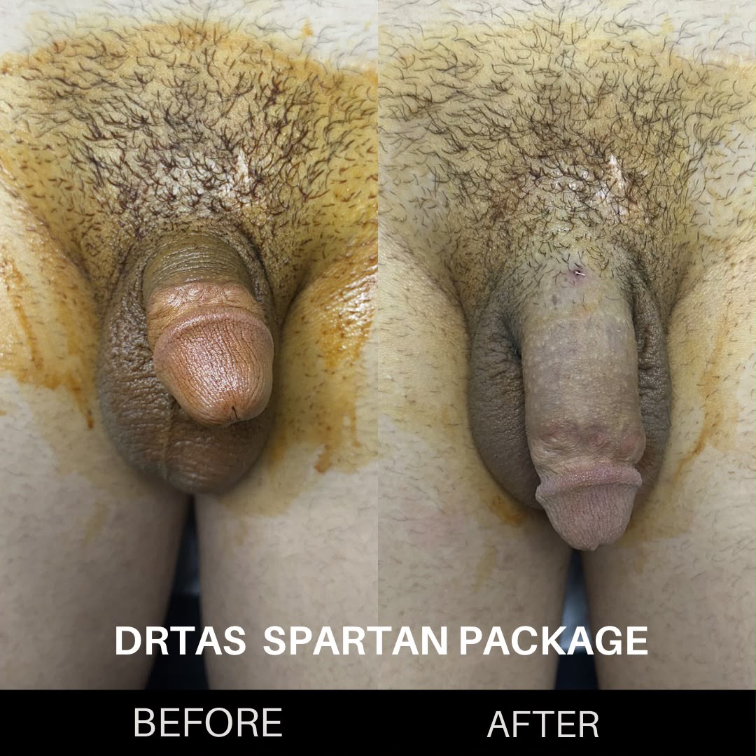 Penile Enlargement before and after result 8