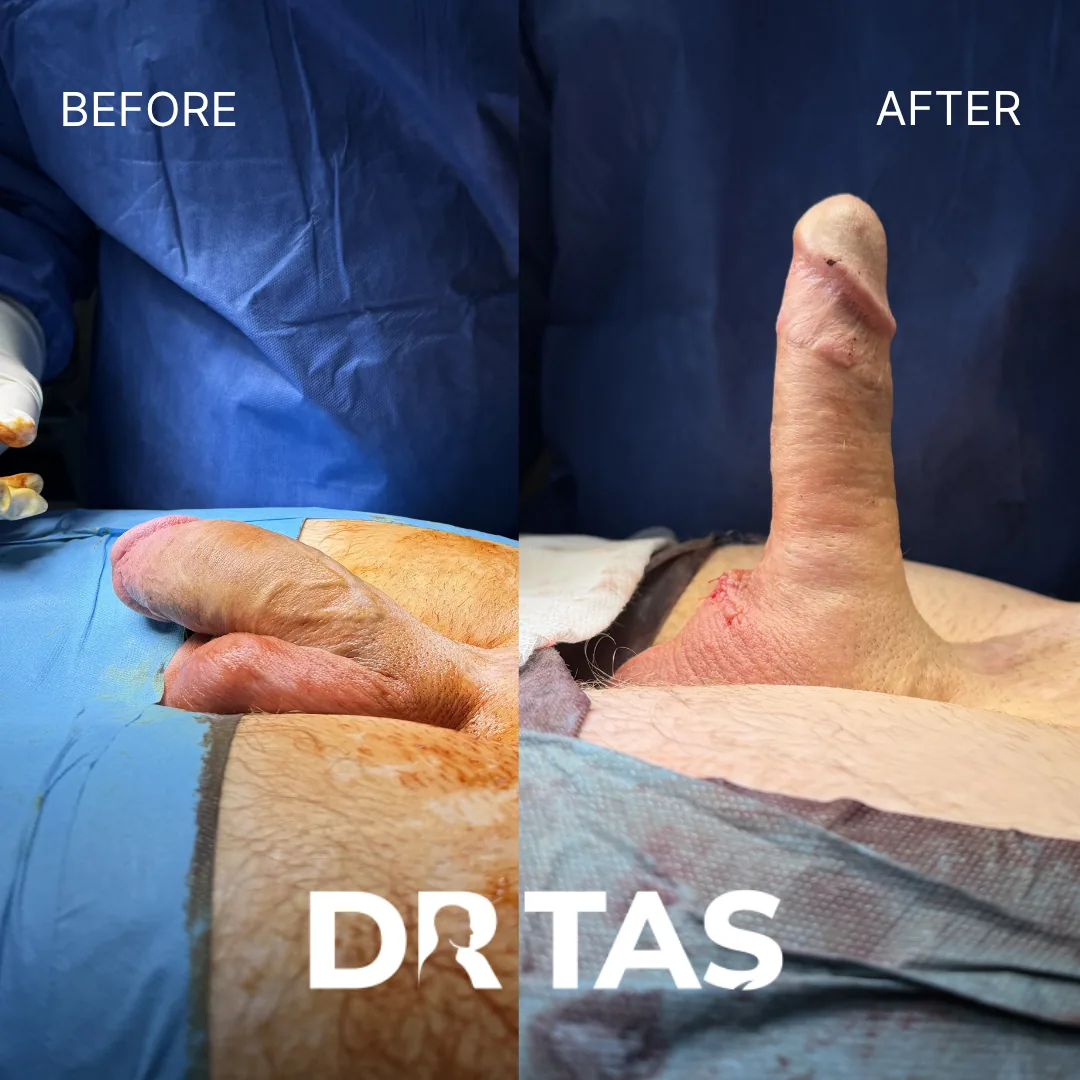 Penile Implant before and after result 1