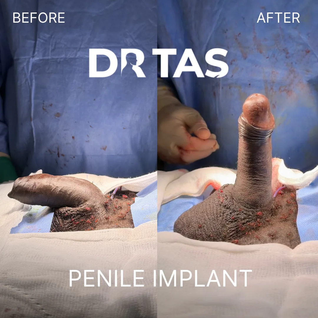 Penile Implant before and after result 2
