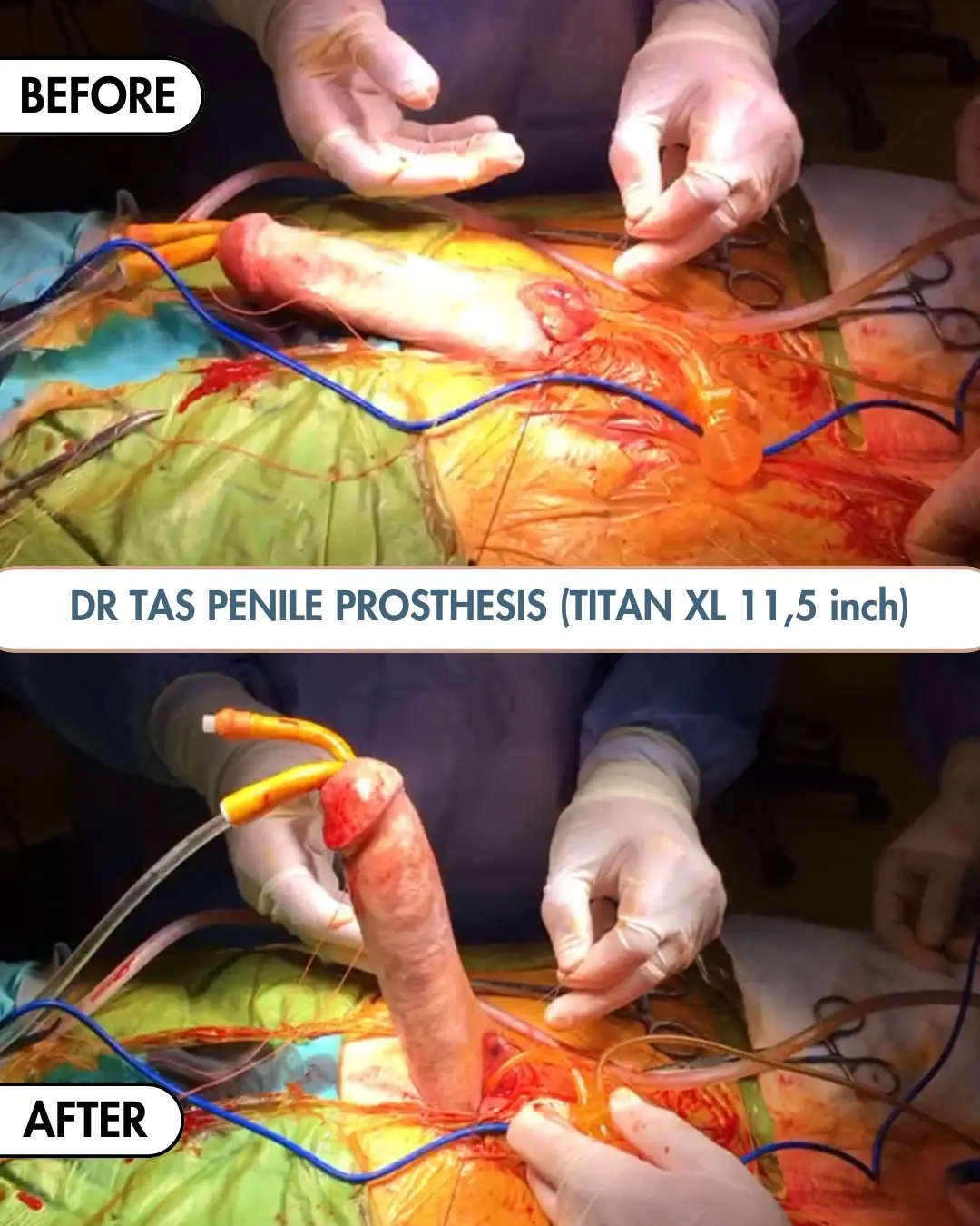 Penile Implant before and after result 13