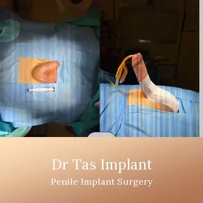 Penile Implant before and after result 5