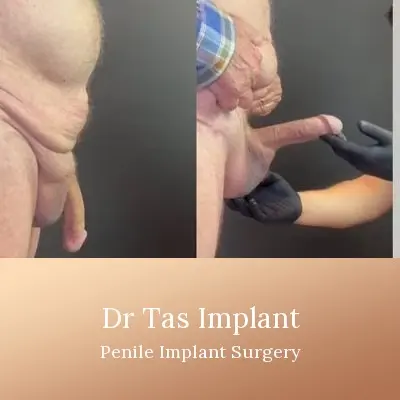 Penile Implant before and after result 6