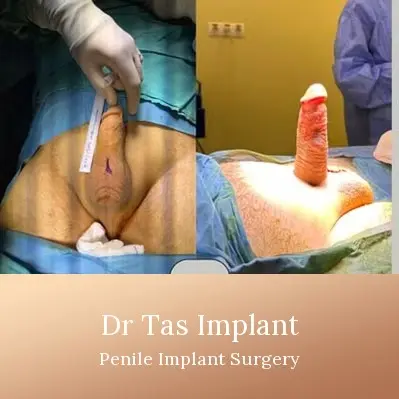 Penile Implant before and after result 7