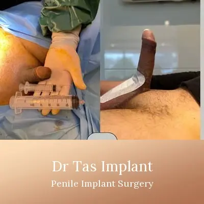 Penile Implant before and after result 3