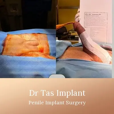 Penile Implant before and after result 9