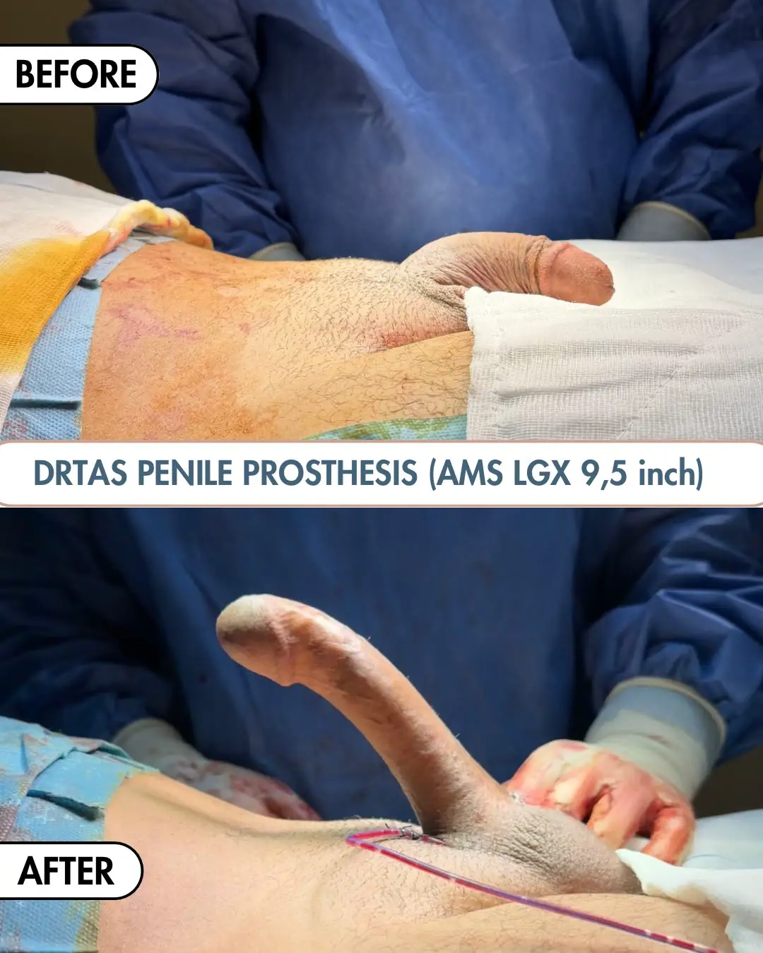 Penile Implant before and after result 10