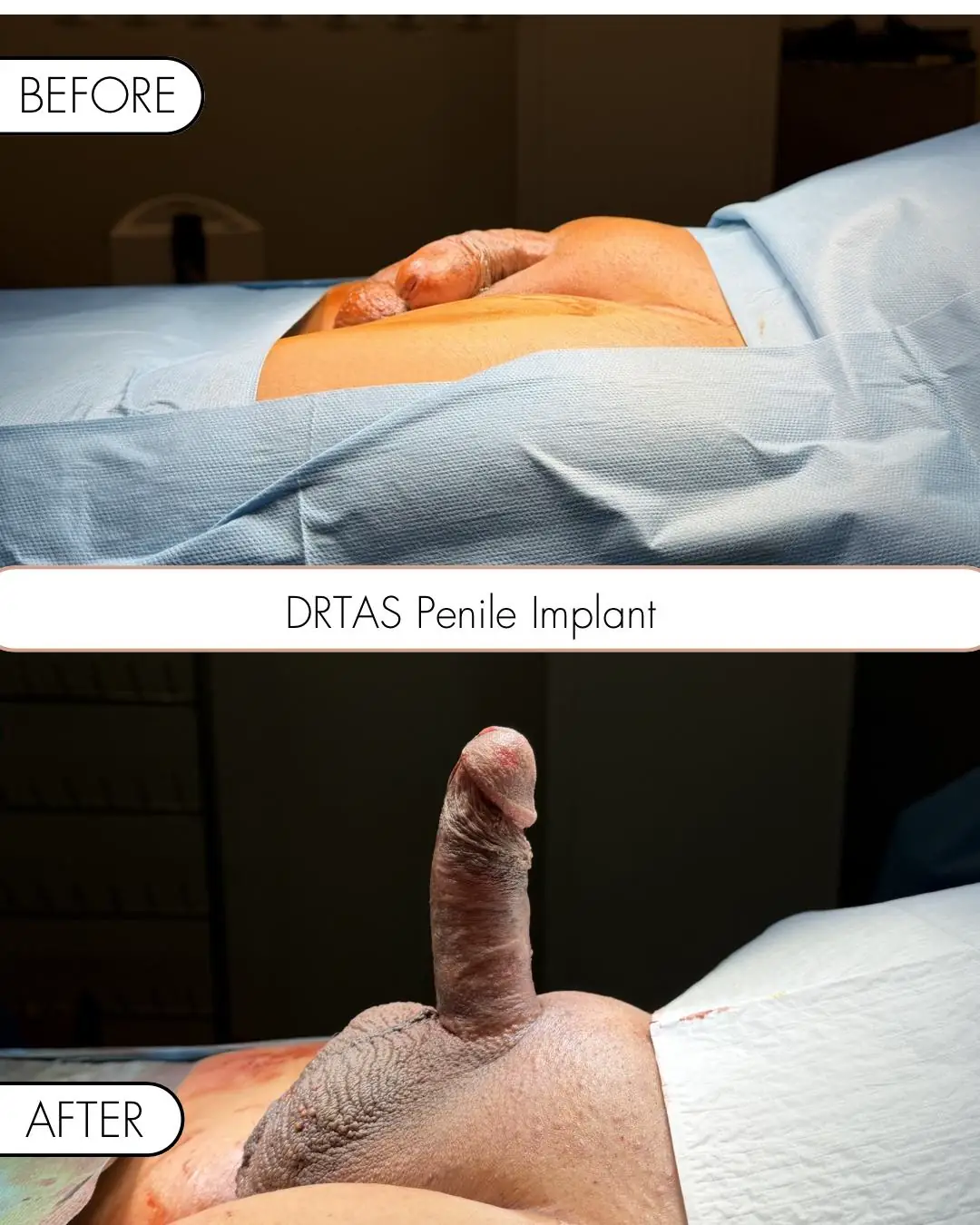 Penile Implant before and after result 11