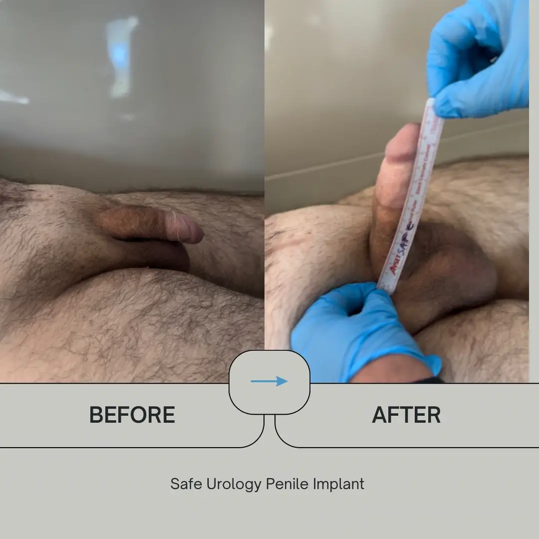 Penile Implant before and after result 4