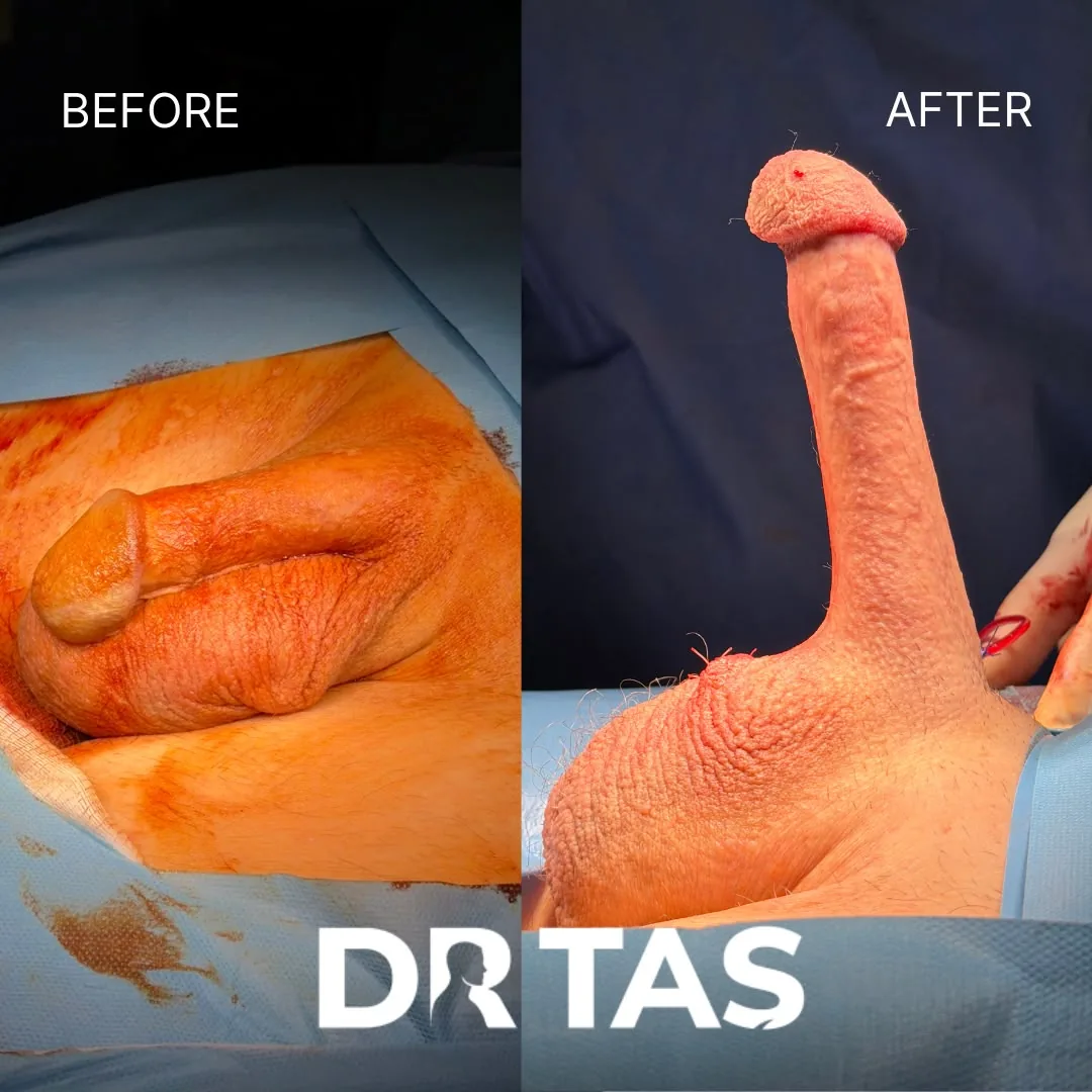 Penile Implant before and after result 14