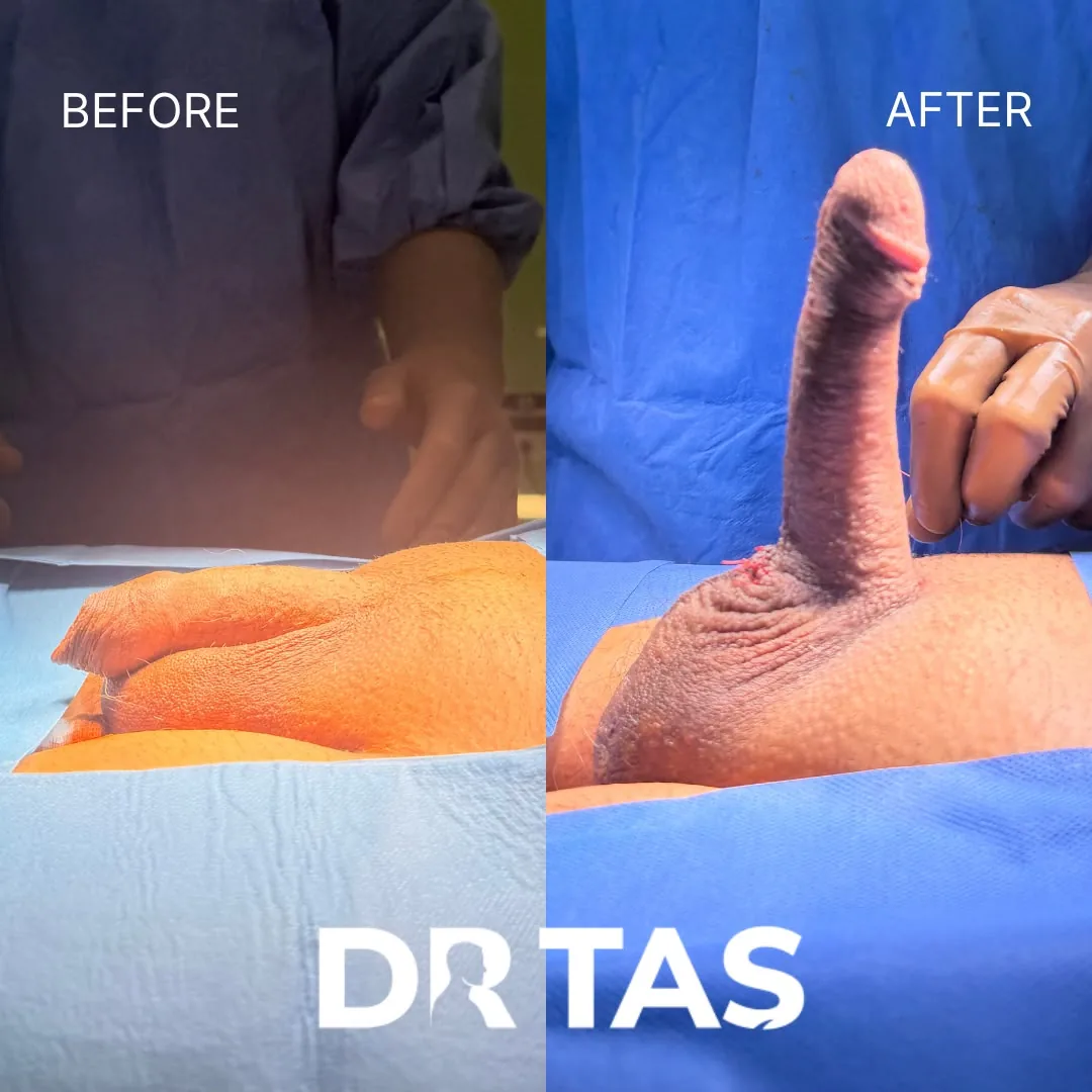 Penile Implant before and after result 15