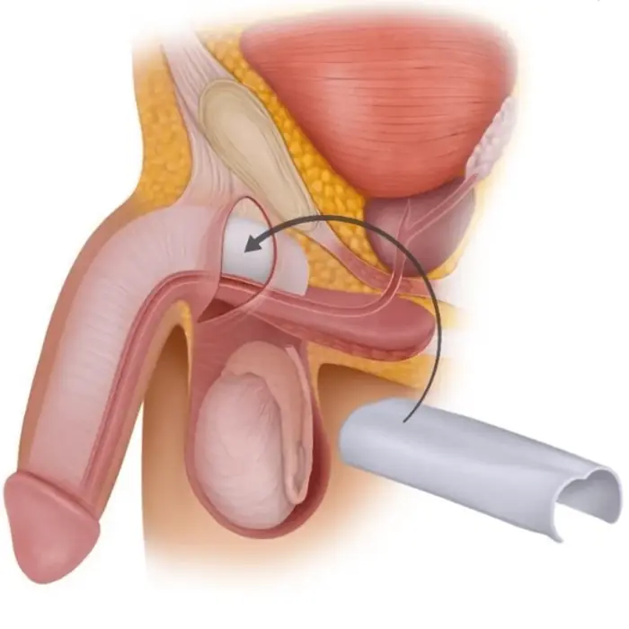 Silicone girth penile implant