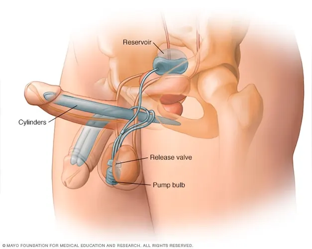 Three piece inflatable penile implant