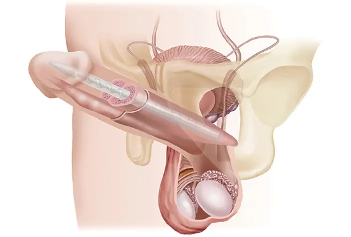 Malleable penile implant
