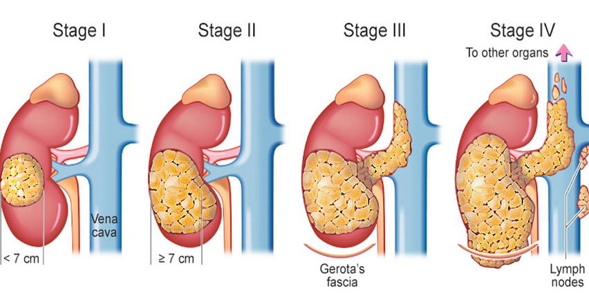 Medical illustration comparing the four stages of kidney cancer: stage I a tumour under 7 centimetres inside the kidney, stage II a tumour of 7 centimetres or more still inside the kidney, stage III a tumour reaching the vena cava or the fat within Gerota's fascia, and stage IV a tumour spreading beyond Gerota's fascia to lymph nodes and other organs