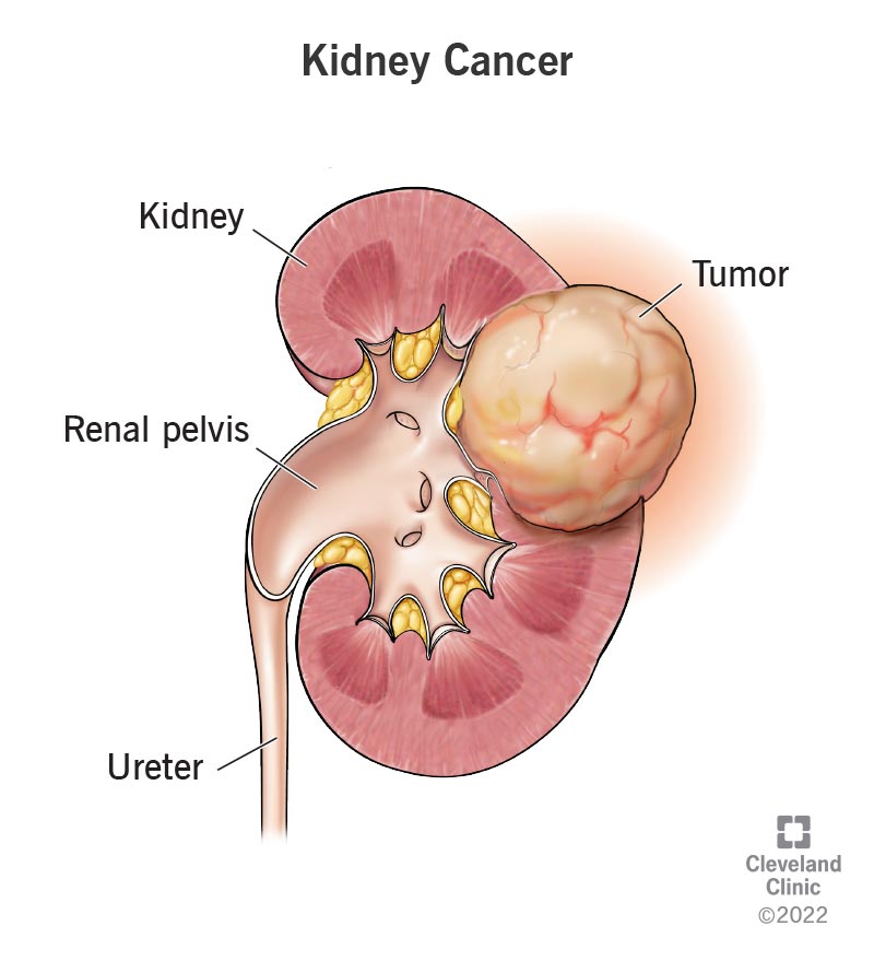 Medical illustration of kidney cancer in cut away view, showing a tumour growing from the outer surface of the kidney alongside the labelled renal pelvis and ureter