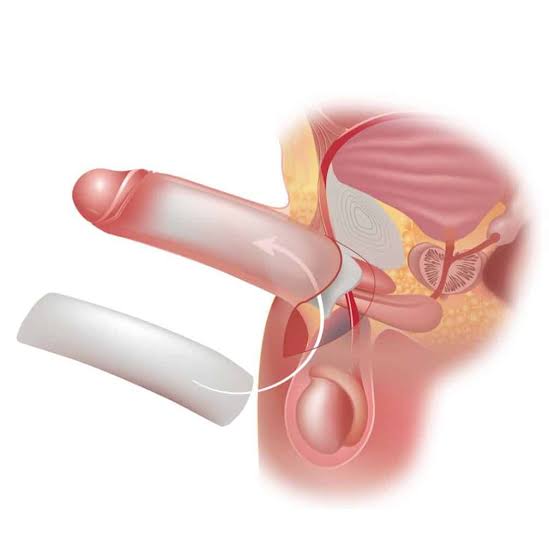Penile enlargement illustration showing the anatomy treated in the procedure