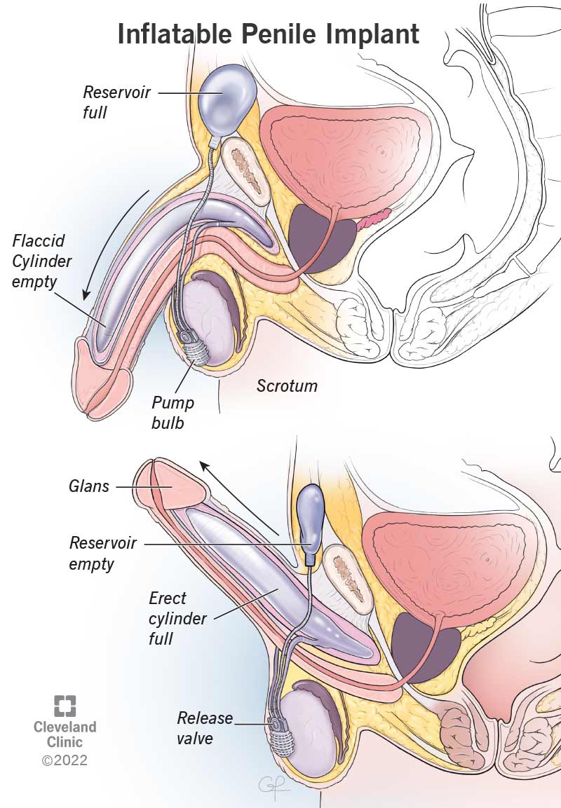 Penile implant surgery in Turkey with Assoc. Prof. Tuncay Taş