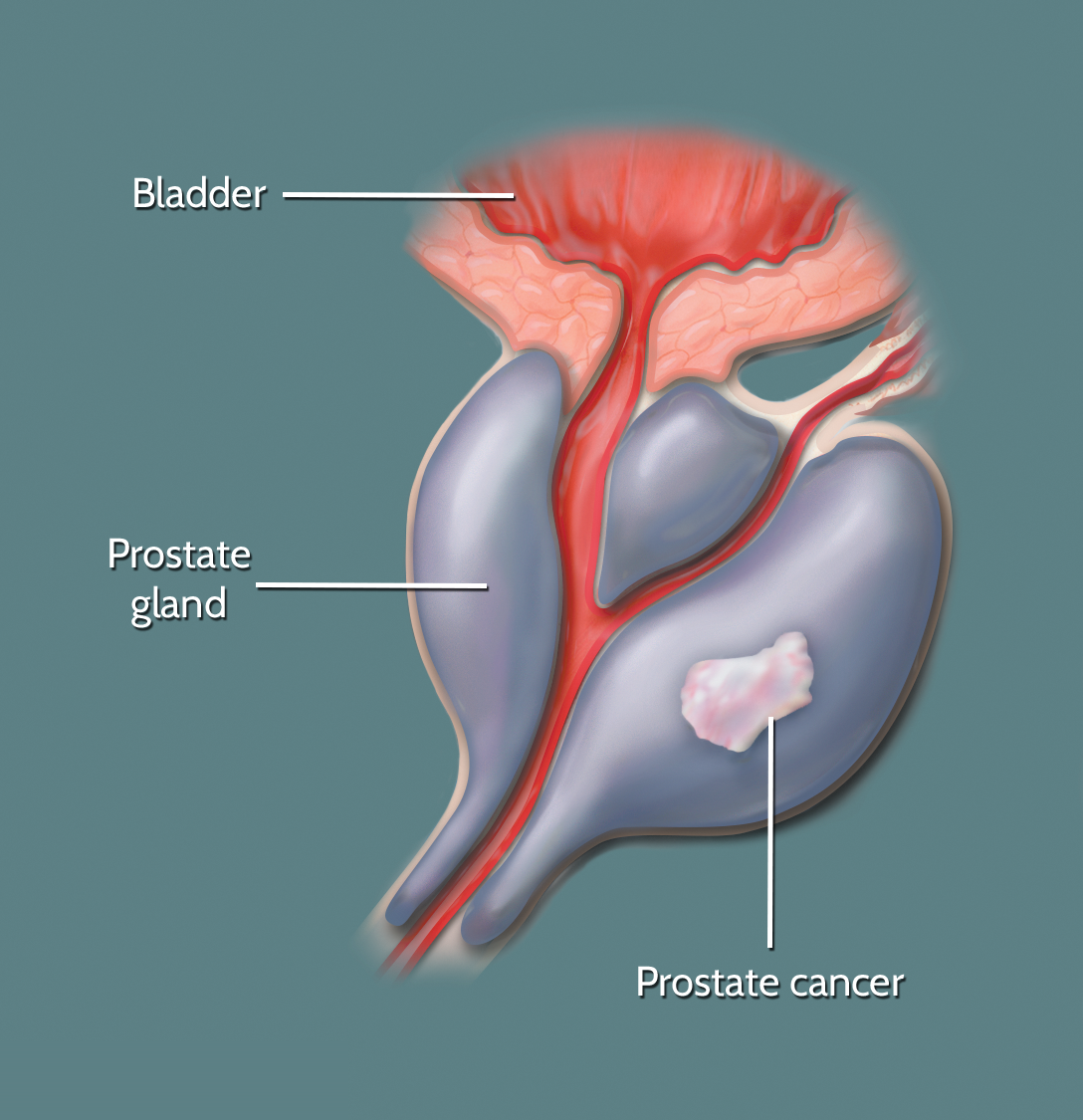 Medical illustration of the prostate gland and bladder showing the location of a prostate cancer tumour